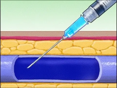 靜脈注射